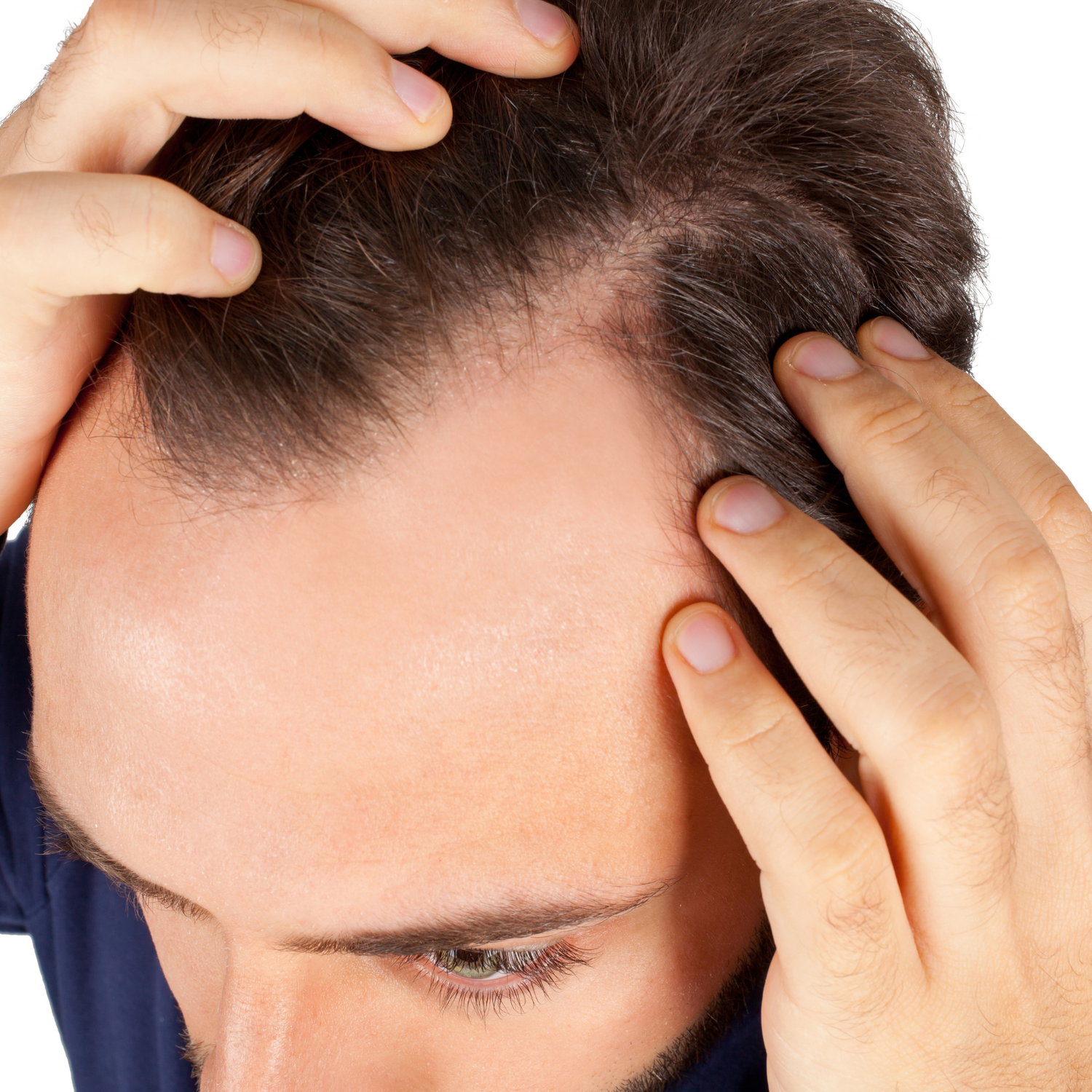 Hair Loss